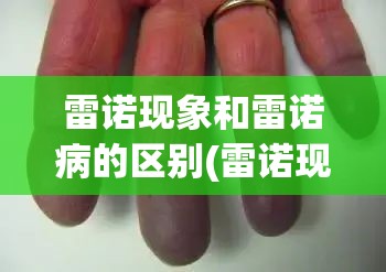 雷诺现象和雷诺病的区别(雷诺现象和雷诺综合征的区别)