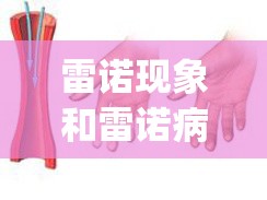 雷诺现象和雷诺病的区别(雷诺现象和雷诺综合征的区别)